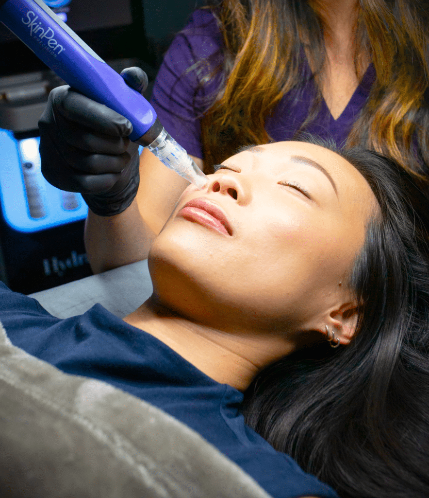 SkinPen Microneedling