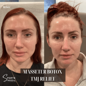 Masseter Botox in San Diego