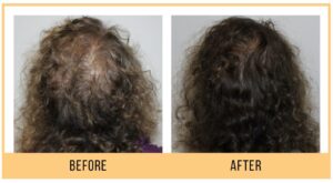 Keravive Before and After