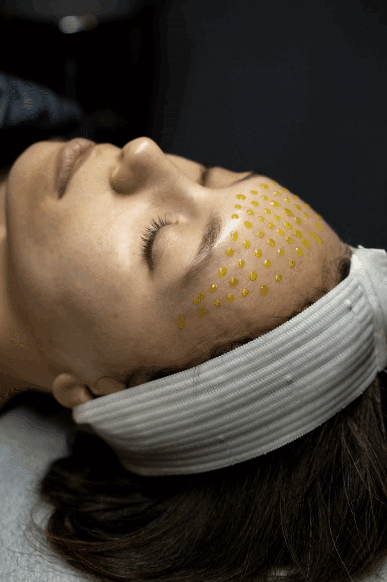 Chemical Peel in San Diego