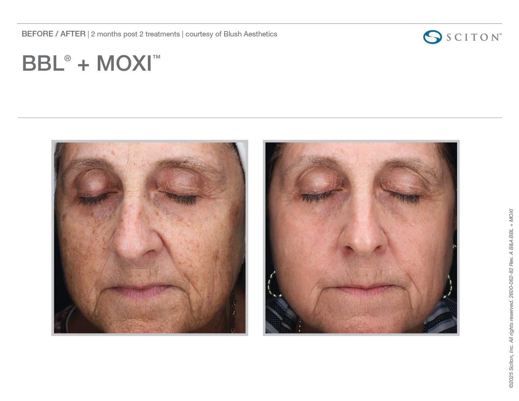 Skin Laser Treatment in San Diego: Everything You Need to Know