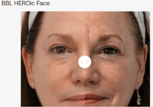 BBL Laser treatment in San Diego