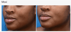 Moxi Laser Treatment in San Diego